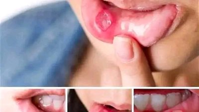 علاج قرح الفم في المنزل بـ4 خطوات بسيطة.