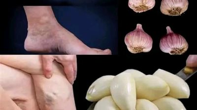 لا يصــدق! تخلـص من دوالي الأوردة العنكـبوتية الزرقاء بشكل طبيعي ! إنها معجزة! .