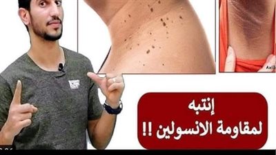 كيفية التخلص من مقاومة الانسولين