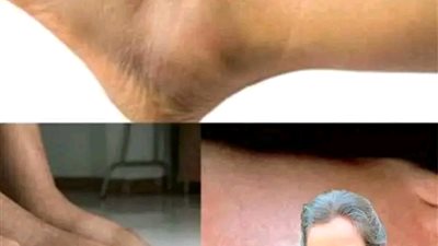 فيتامين رقم 1 لإزالة انتفاخ الساق والقدمين! 