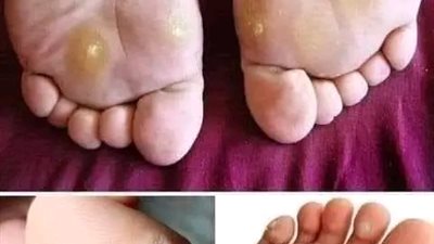 إليكم أسهل وأقوى طرق علاج مسمار القدم 