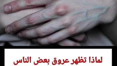 لماذا تظهر عروق بعض الناس من الجلد وتختفي عند آخرين 