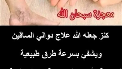 كنز جعله الله علاج دوالي الساقين ويشفي بسرعة طرق طبيعية لمحاربة الأوردة العنكبوتية ودوالي الساقين 