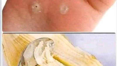 مسمار اللحم او عين السمكة الي تقريبا الطب عجز عنه علاجه ببطانه قشر الموز