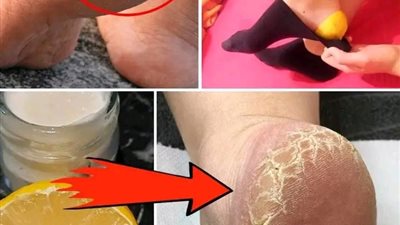 الكعب المتشقق علاج الجدات الذي لا يمكن الاستغناء عنه لأن مفعوله بعد نص ف ساعة أو ساعة