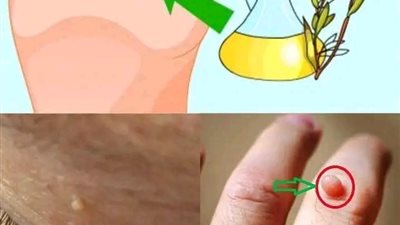 اسرع علاج منزلي طبيعي وفعال للتخلص من الزوائد الجلدية