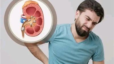 9 علامات تشير إلى خروج الحصوات من الكلى.
