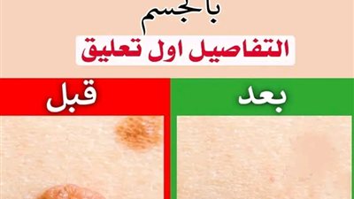 ما هي اسباب ظهور الزوائد الجلدية في اي منطقة في الجسم وكيفية علاجها بطرق بسيطة وطبيعية.