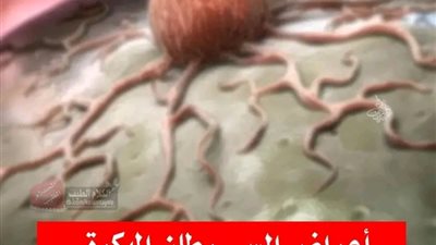 أعراض السړطان المبكرة التي تظهر قبل خمس سنوات من المړض 