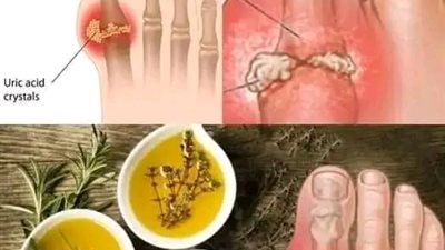 8 طرق سهلة لإزالة حمض اليوريك الزائد