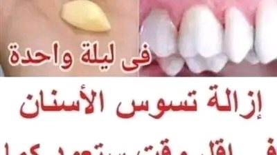 ودا عـا لطبـيب الأسـنان مع هذه الوصفة الـحرية التي تقضي على مشاكل الأسنـان وتزيل الجير وتجعل اسنانك بيضاء كالثلج في 72 ساعة 