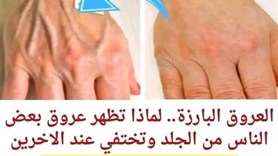 العروق البارزة.. لماذا تظهر عروق بعض الناس من الجلد وتختفي عند الاخرين 