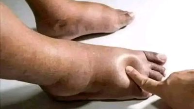 لكل من يعاني من احتباس السوائل في الجسم و المسببة زيادة في الوزن و مشاكل صحية هقولكم العلاج لحل هذه مشكلة نهائيا 
